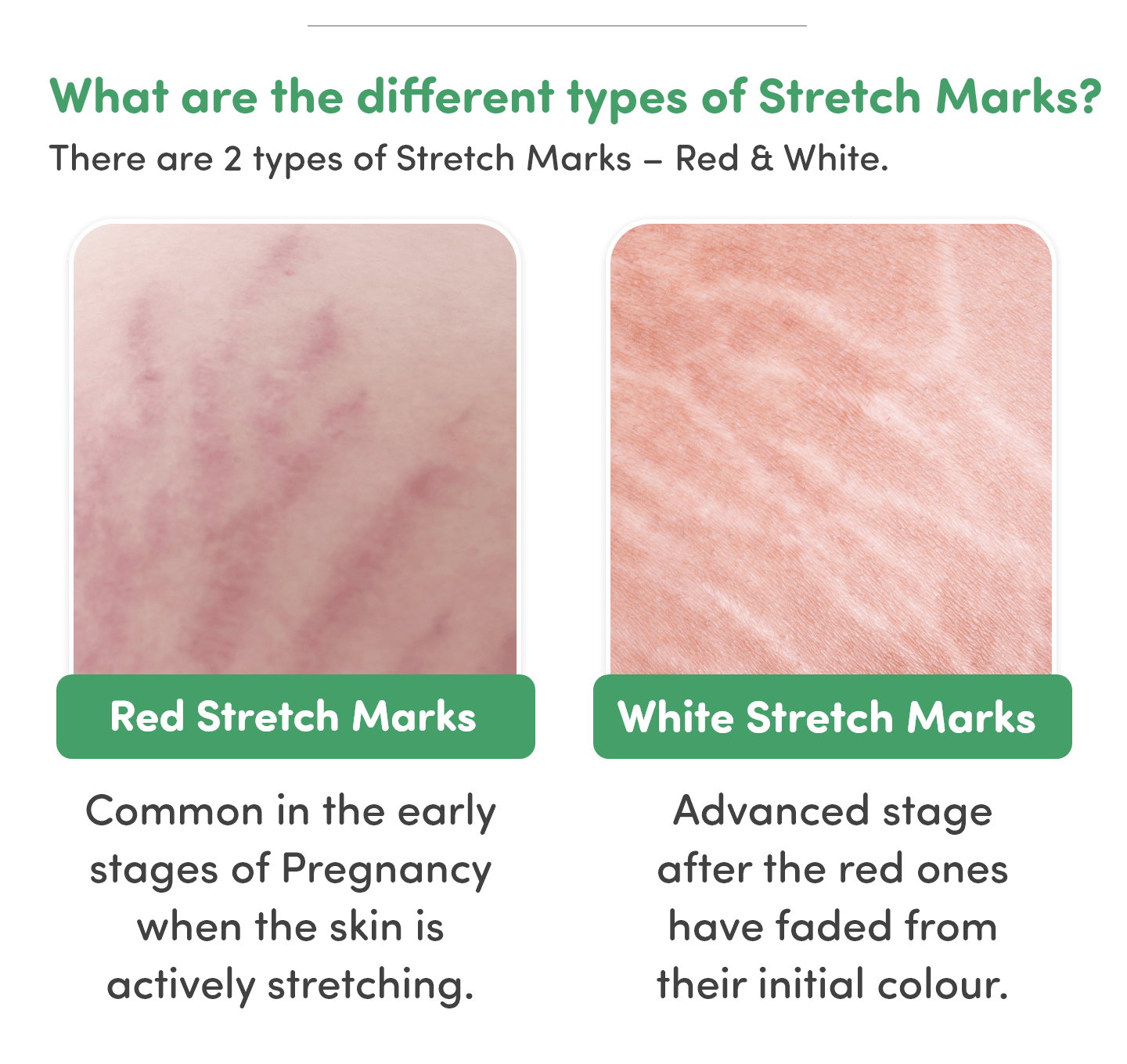 Different types of Stretch Marks? 