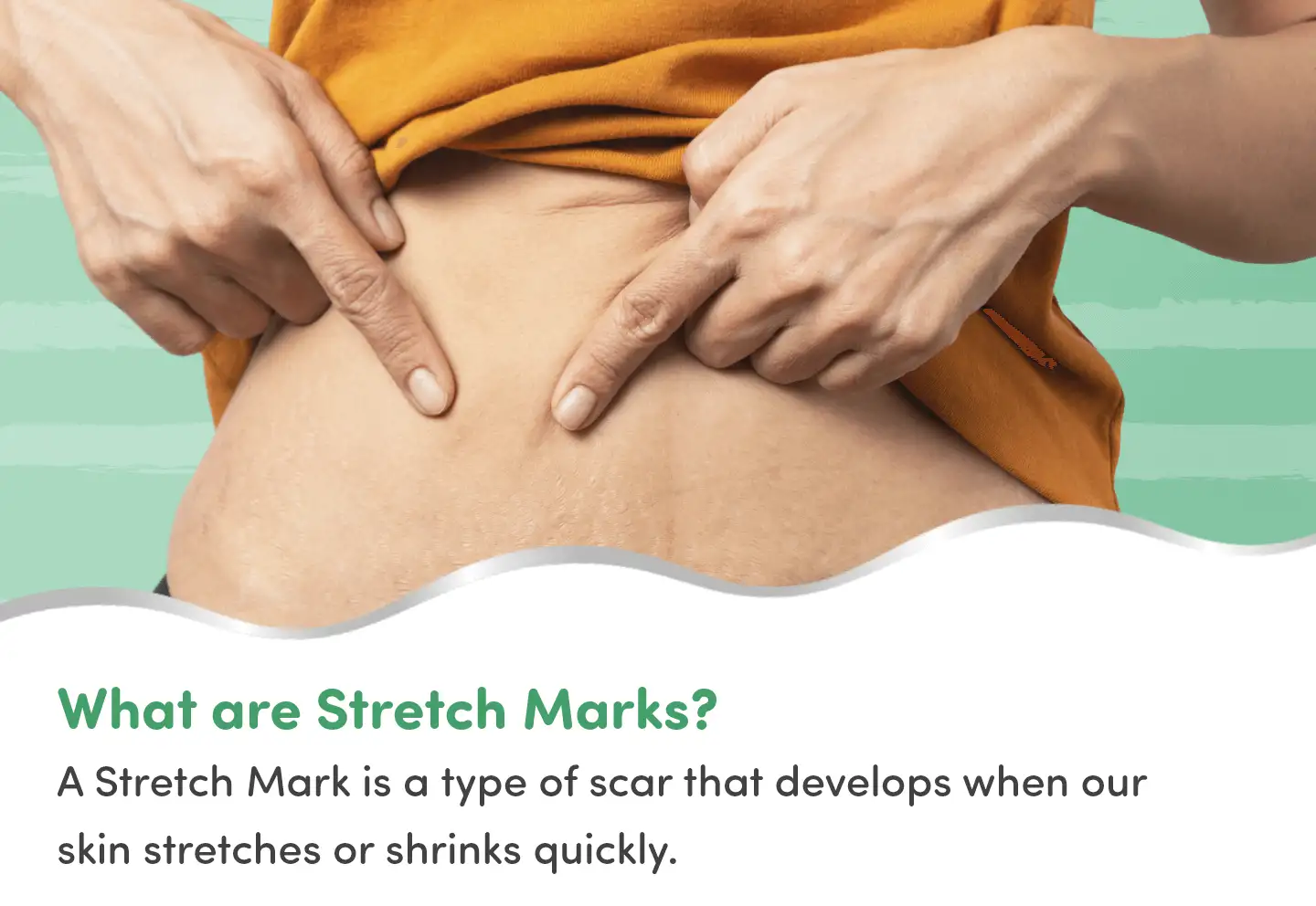 What are stretch marks