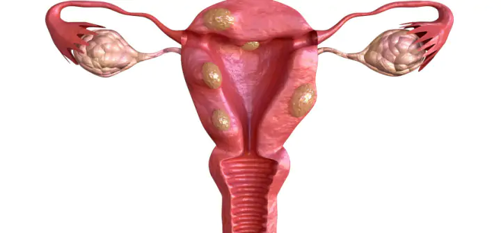 Bulky Uterus: symptoms, causes and treatment - IVI