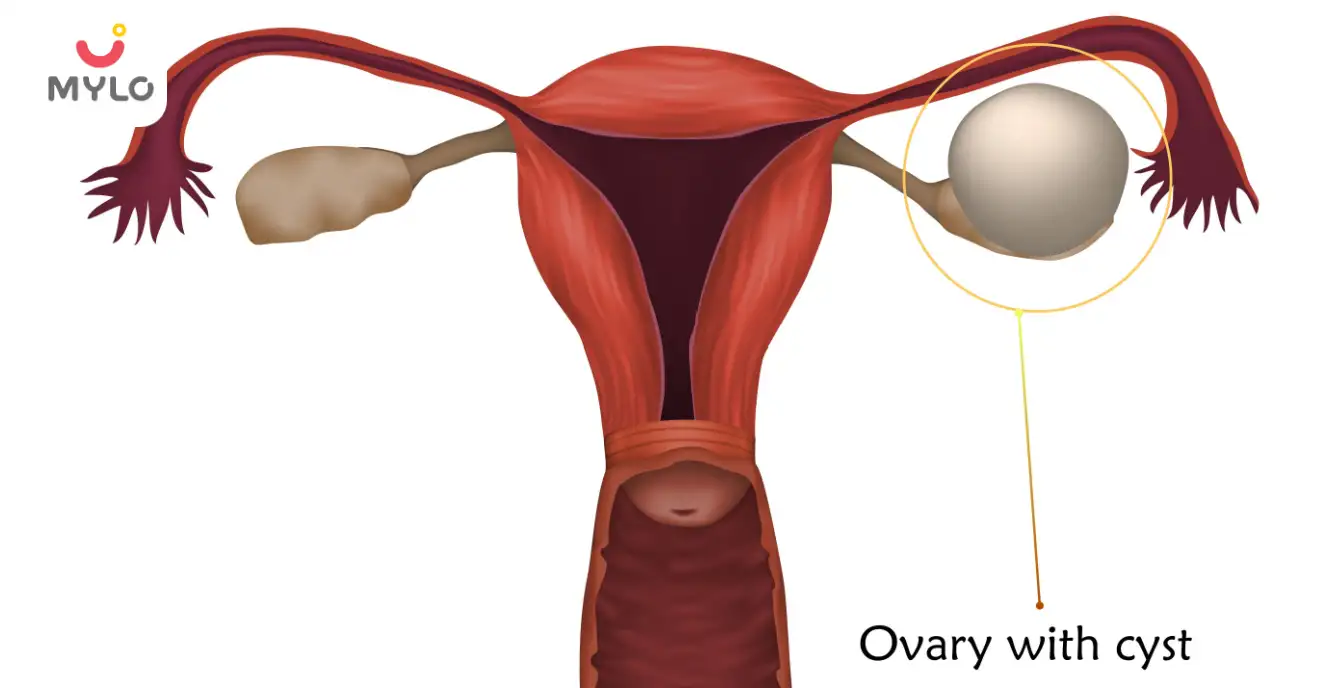 How to get pregnant with ovarian cysts?