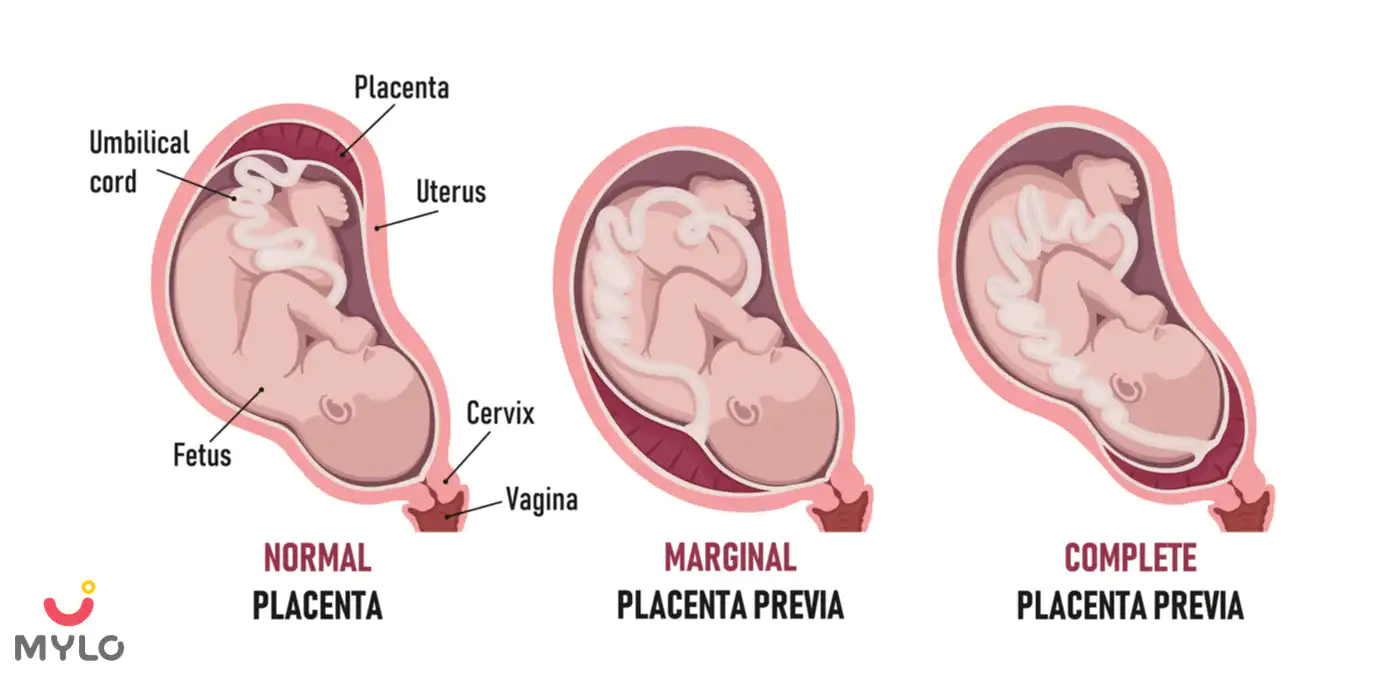 Image related to Low Lying Placenta