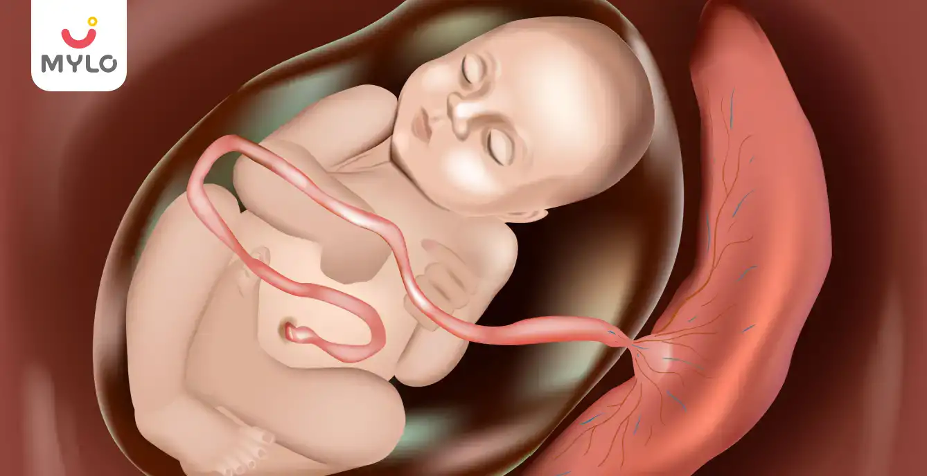 Image related to Placental Abruption