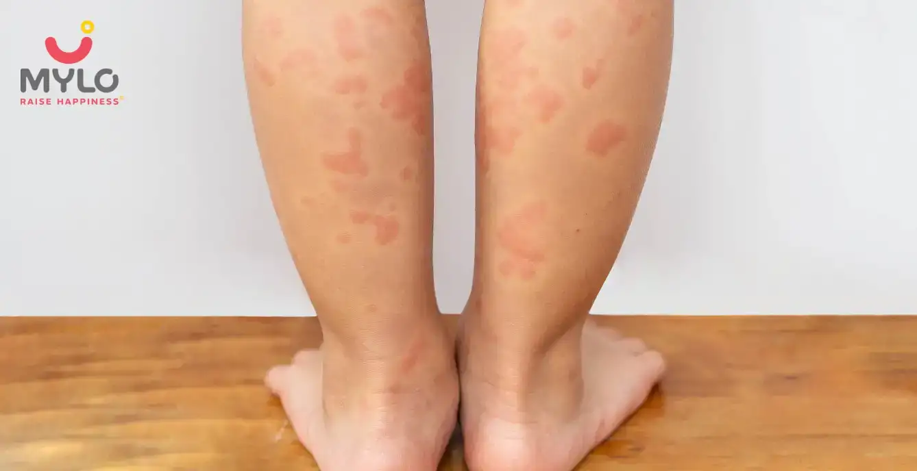 Treatment for Hives in toddlers 
