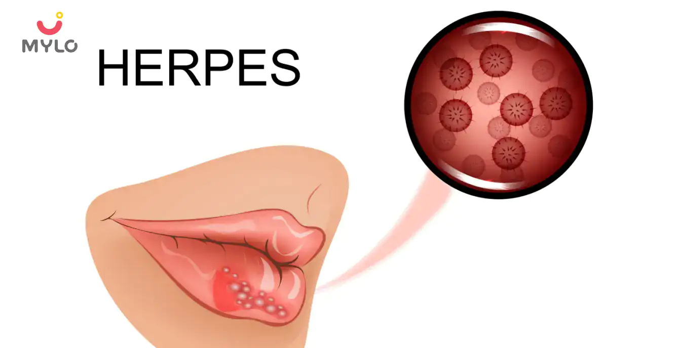 Herpes: Causes, Symptoms, Risk & Treatment