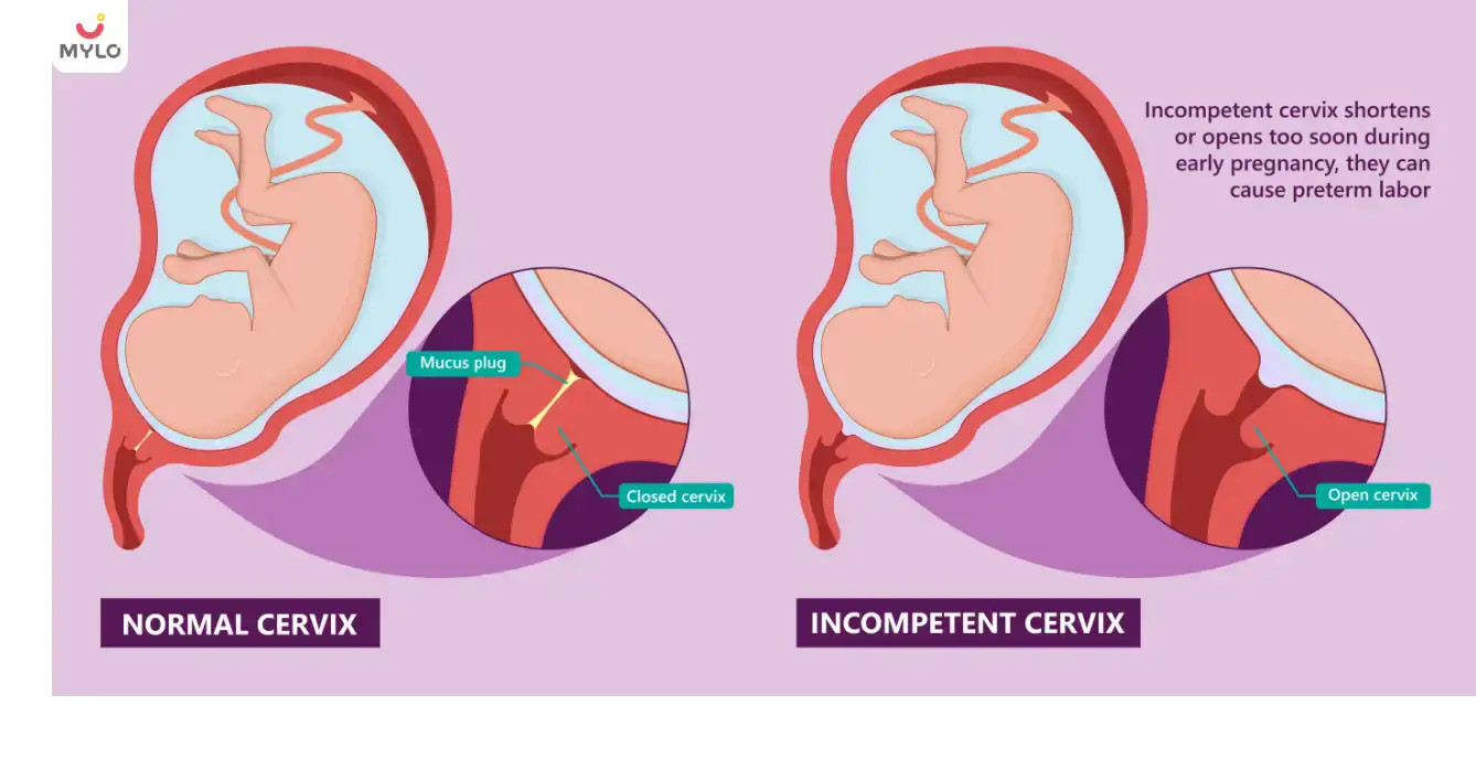 Incompetent cervix: Causes, Symptoms, & Treatment