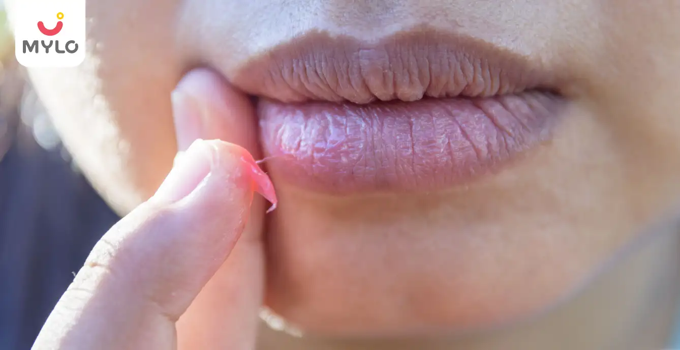 Dry Lips During Pregnancy: Causes and Expert Tips for Relief