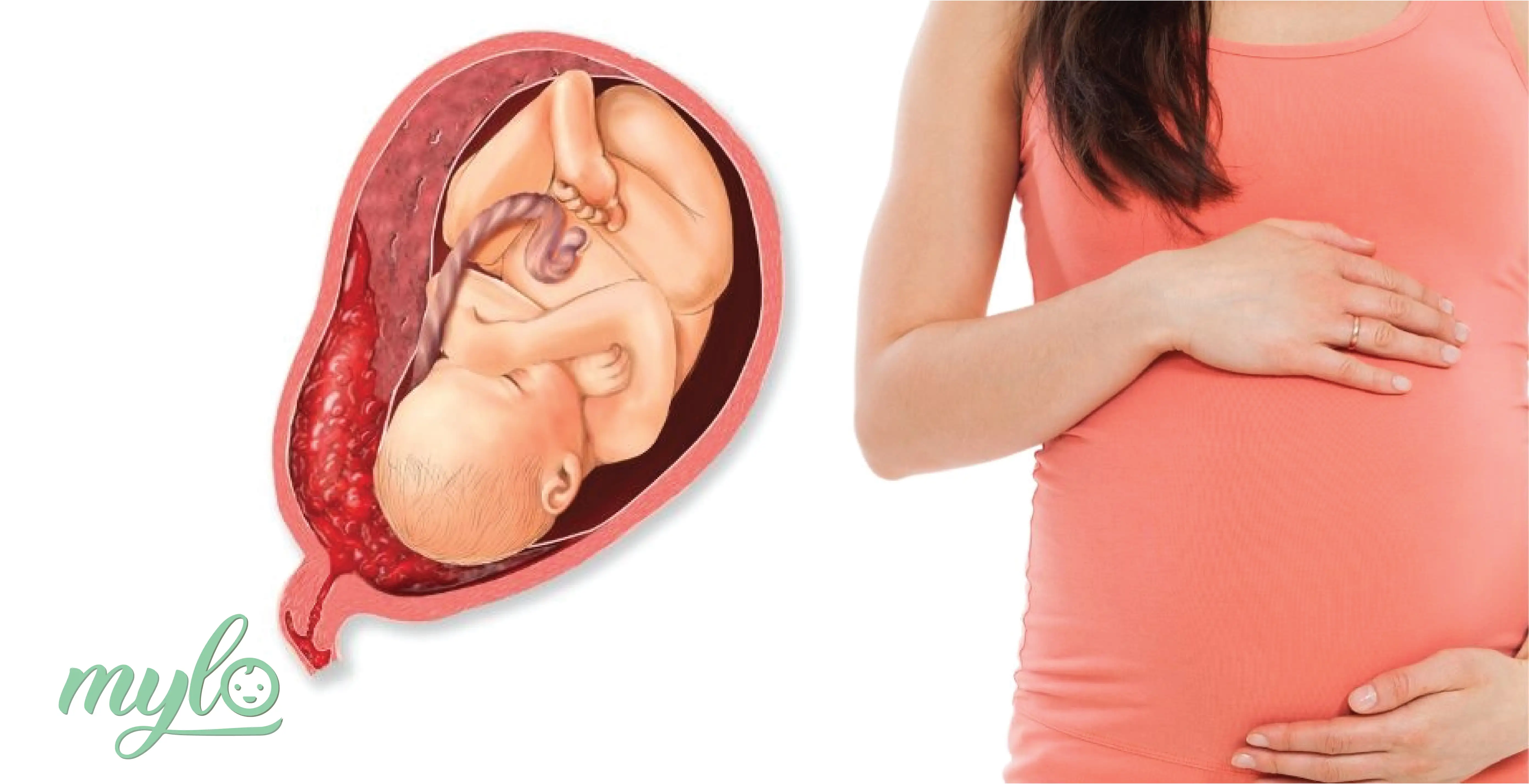 Image related to Low Lying Placenta