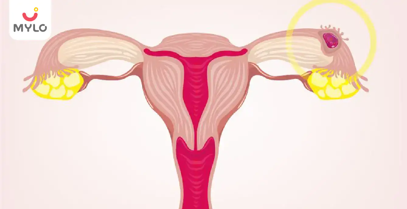 How to Detect Ectopic Pregnancy Early