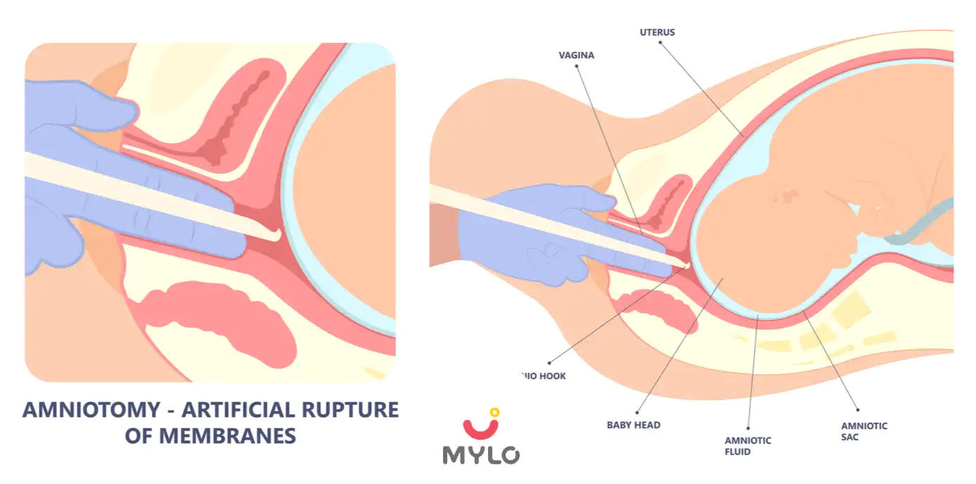 Image related to Premature Delivery