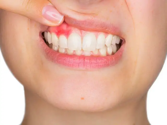 Pregnancy Gingivitis, how do hormones affect your gums? 