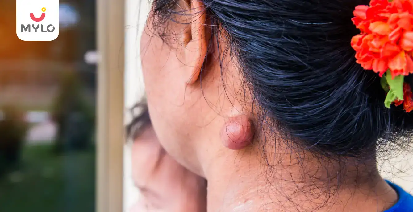 What is Sebaceous Cyst: Causes, Symptoms & Treatment