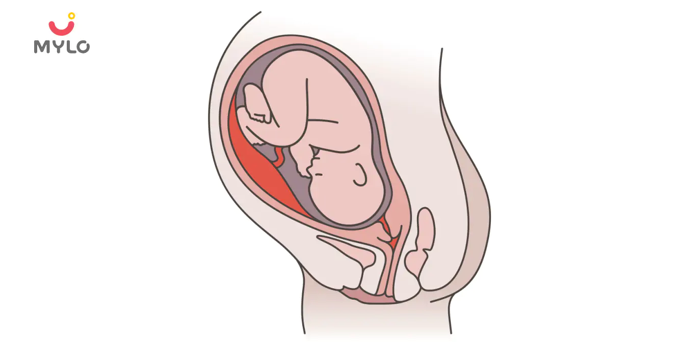 Image related to Umbilical Cord Complications