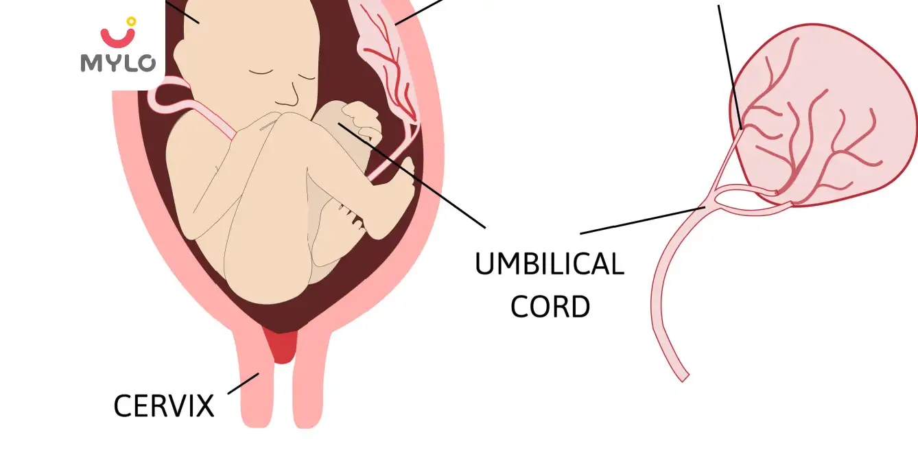 Image related to Umbilical Cord Complications