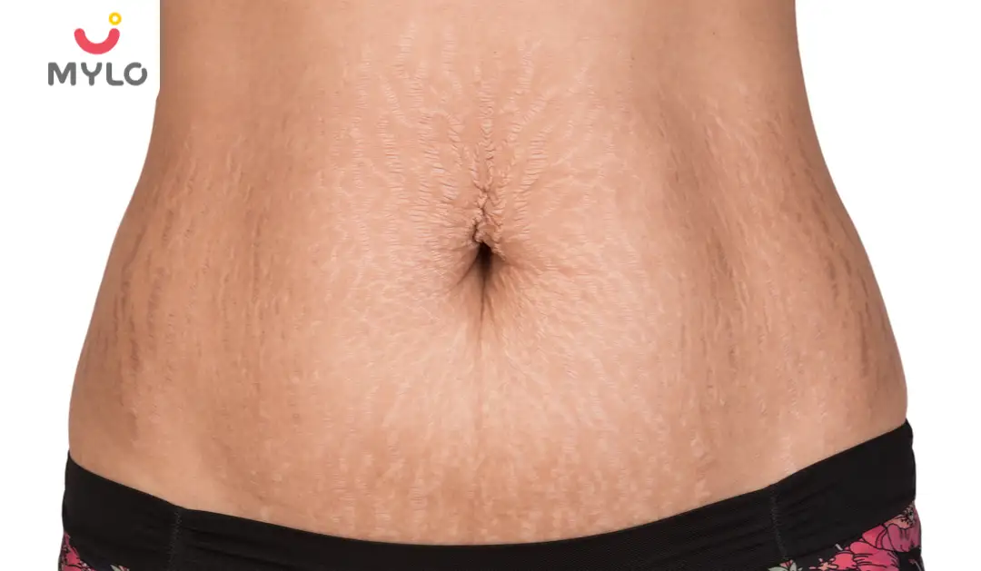 Image related to Stretch Marks