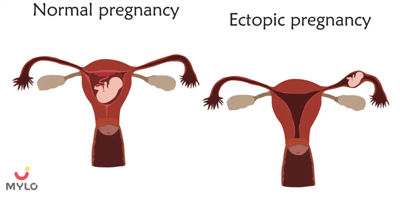 Image related to Pregnancy Complications