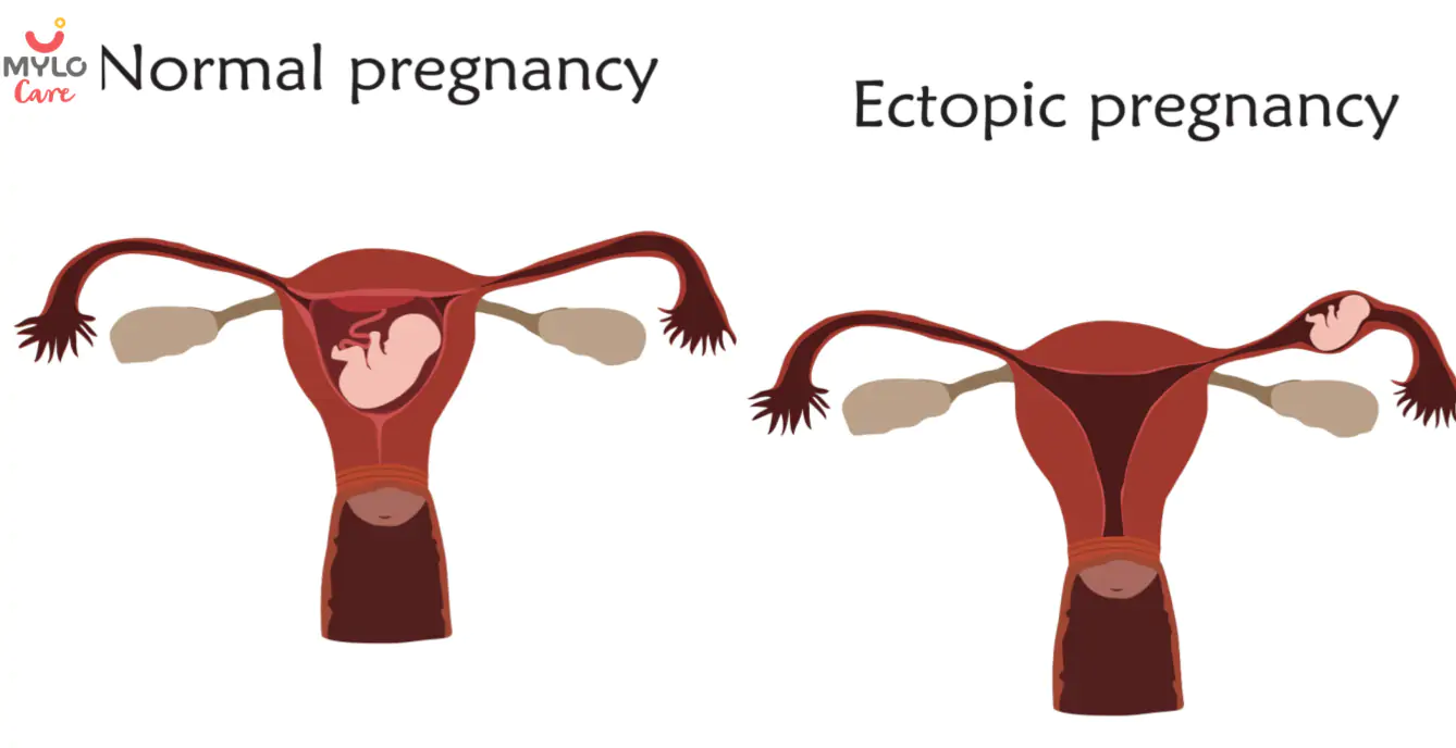 Image related to Pregnancy Complications