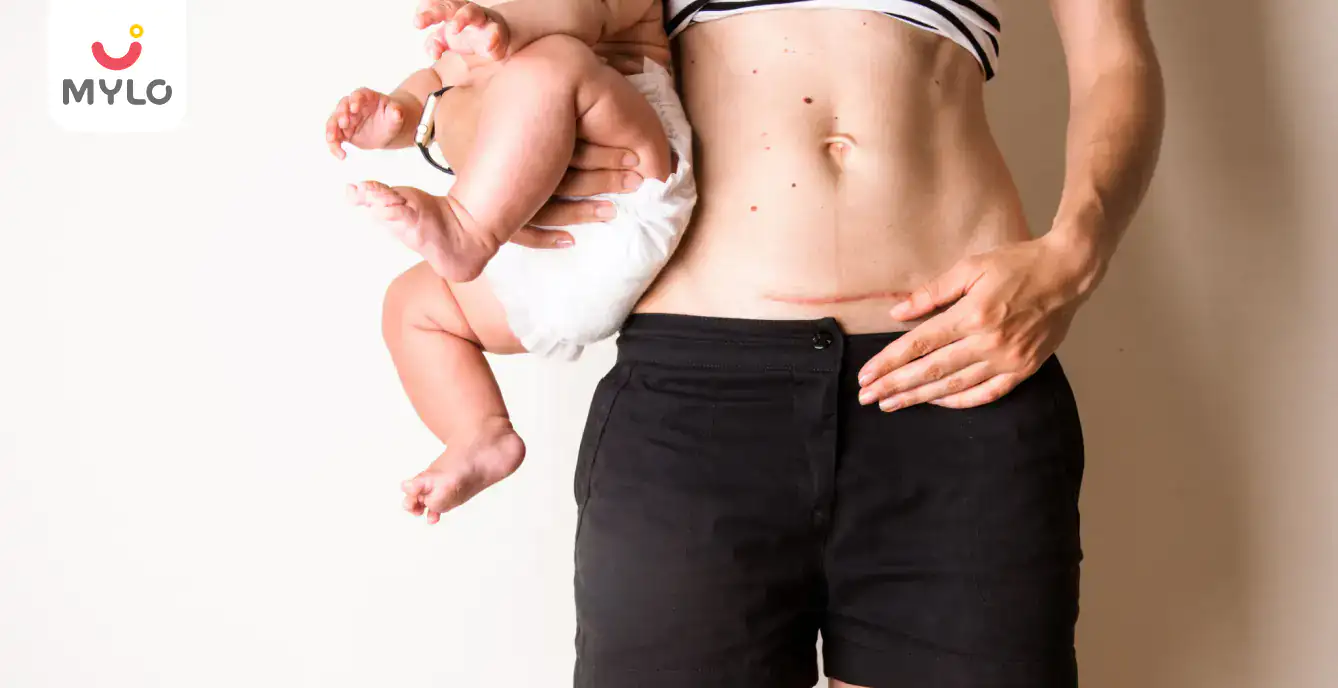 Why Does C-Section Scar Hurt Years Later & What You Can Do About It?
