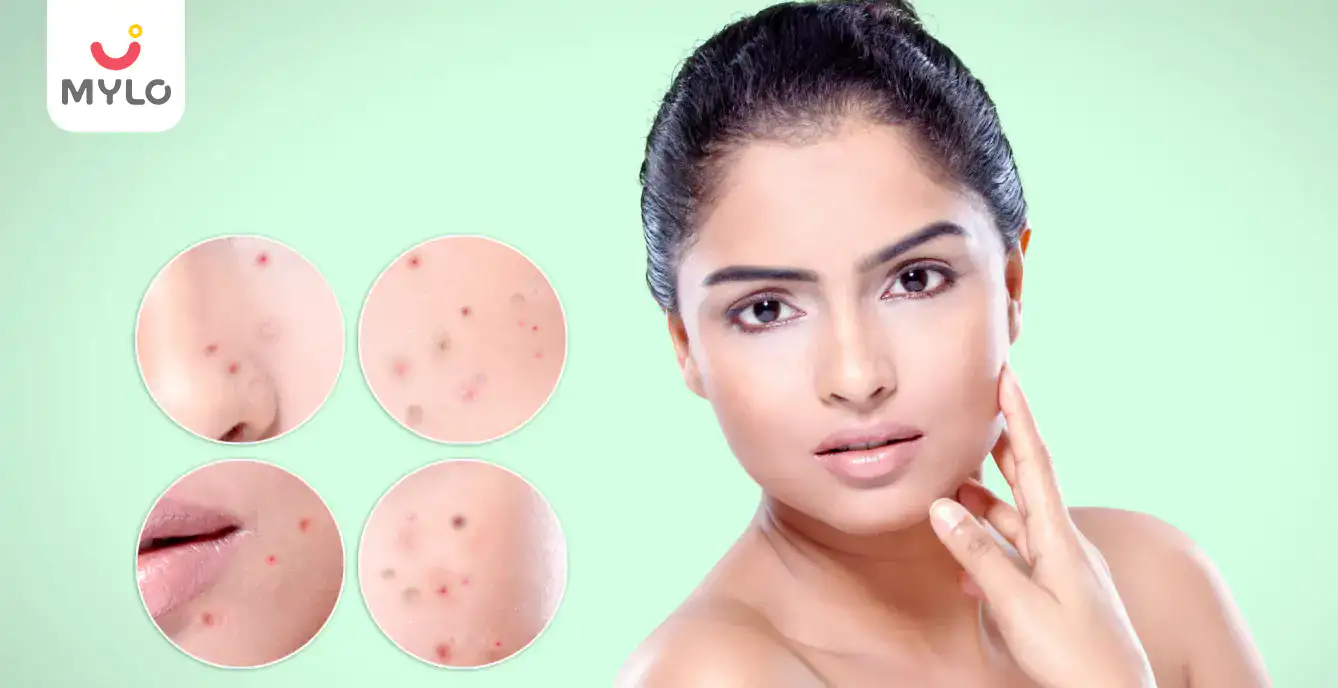 What is acne & how can you get rid of it from the face?