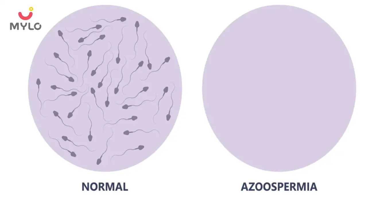 Image related to Male Infertility