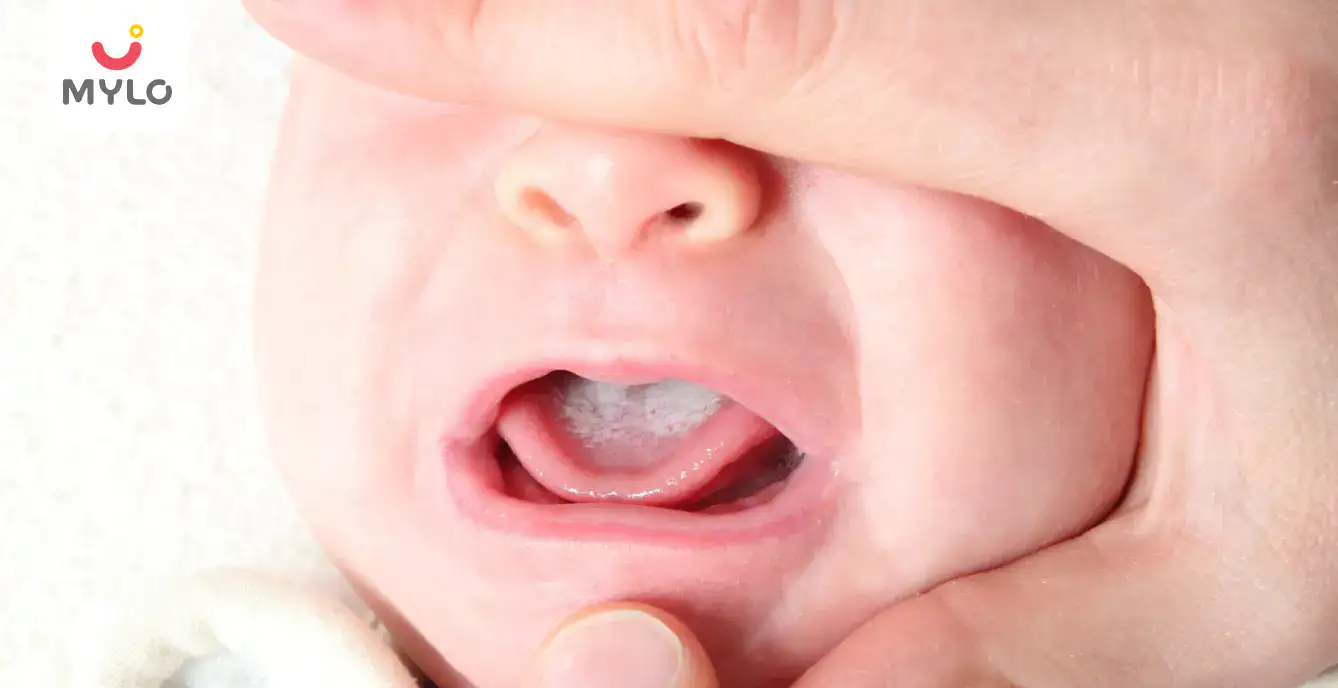 Baby's Mouth Thrush: Symptoms, Causes & Treatment